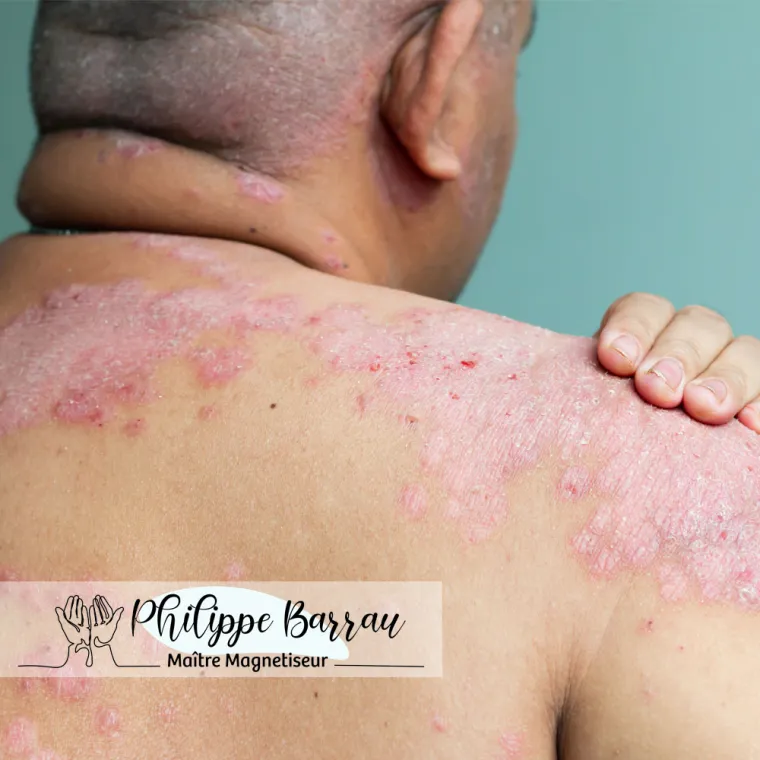 Soulager le psoriasis  - Philippe Barrau Magnétiseur coupeur de feu thérapeute psycho-énergétique à Saint-Rémy-de-Provence